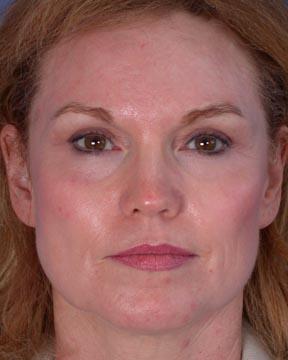 Laser Skin Resurfacing Before & After Image