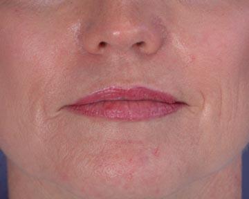 Laser Skin Resurfacing Before & After Image