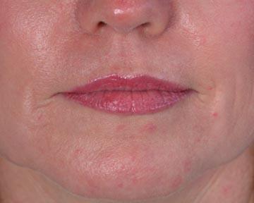 Laser Skin Resurfacing Before & After Image