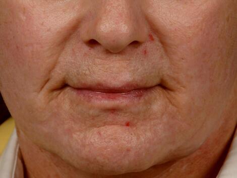 Laser Skin Resurfacing Before & After Image