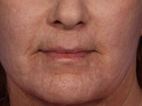 Laser Skin Resurfacing Before & After Image