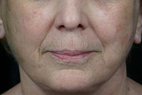 Laser Skin Resurfacing Before & After Image