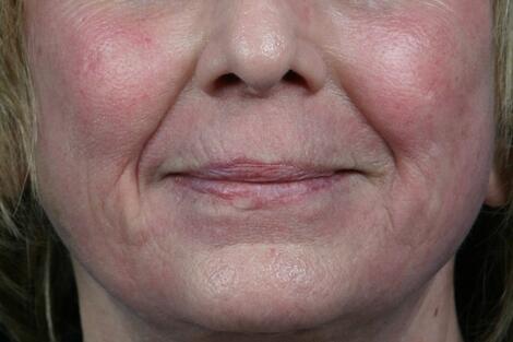 Laser Skin Resurfacing Before & After Image