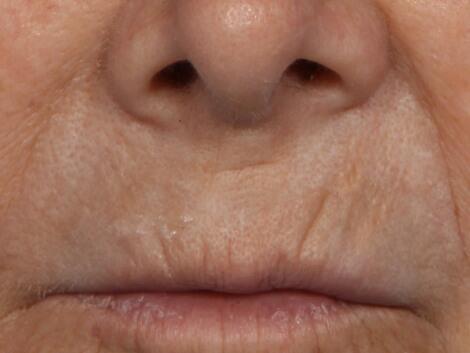 Laser Skin Resurfacing Before & After Image