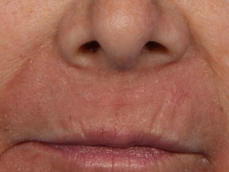 Laser Skin Resurfacing Before & After Image