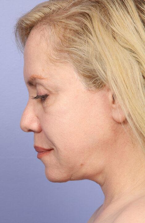 Laser Skin Resurfacing Before & After Image