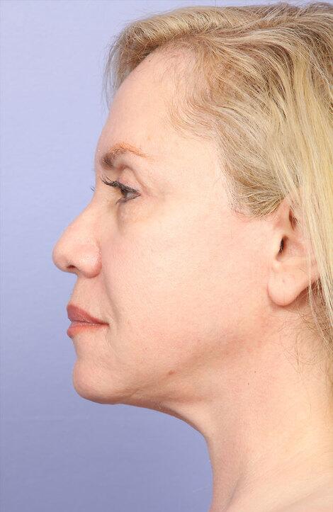 Laser Skin Resurfacing Before & After Image