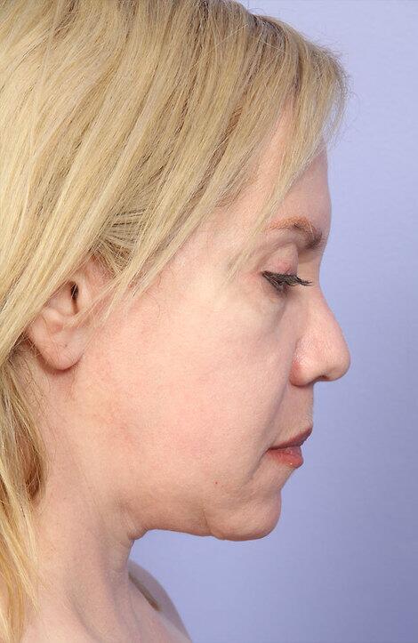 Laser Skin Resurfacing Before & After Image