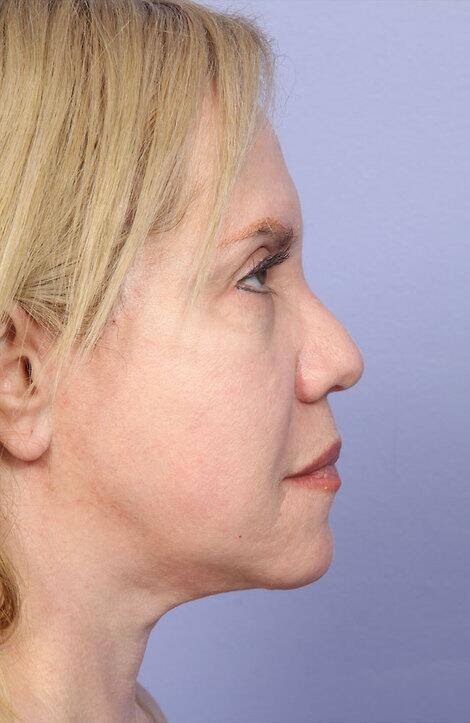 Laser Skin Resurfacing Before & After Image