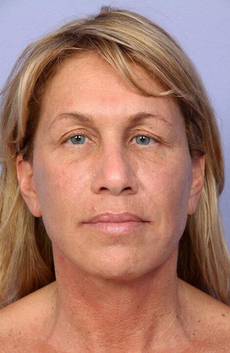 Laser Skin Resurfacing Before & After Image