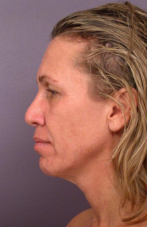 Laser Skin Resurfacing Before & After Image