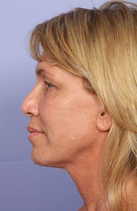 Laser Skin Resurfacing Before & After Image