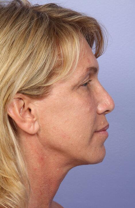 Laser Skin Resurfacing Before & After Image