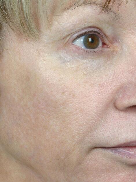 Laser Skin Resurfacing Before & After Image