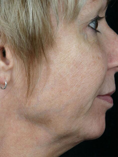 Laser Skin Resurfacing Before & After Image