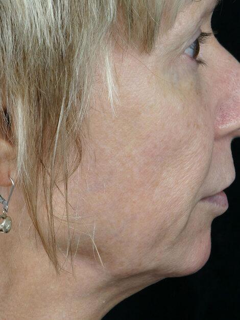 Laser Skin Resurfacing Before & After Image