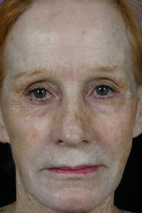 Laser Skin Resurfacing Before & After Image