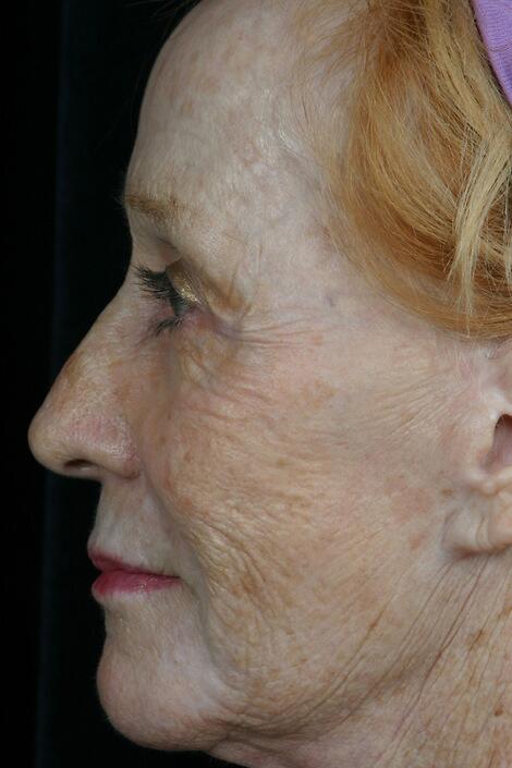 Laser Skin Resurfacing Before & After Image