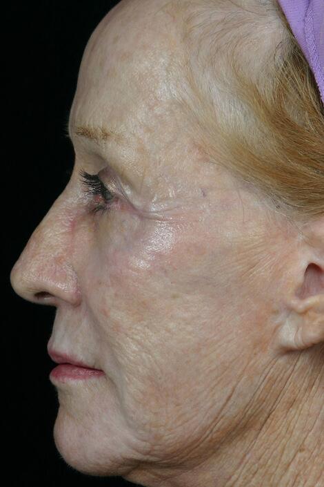 Laser Skin Resurfacing Before & After Image