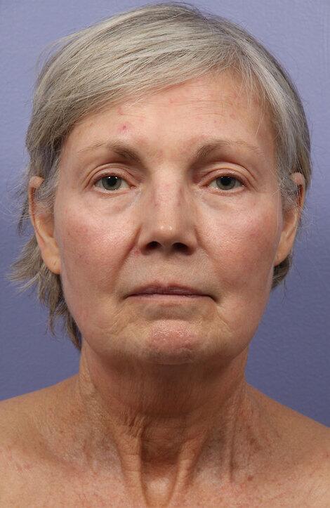 Laser Skin Resurfacing Before & After Image