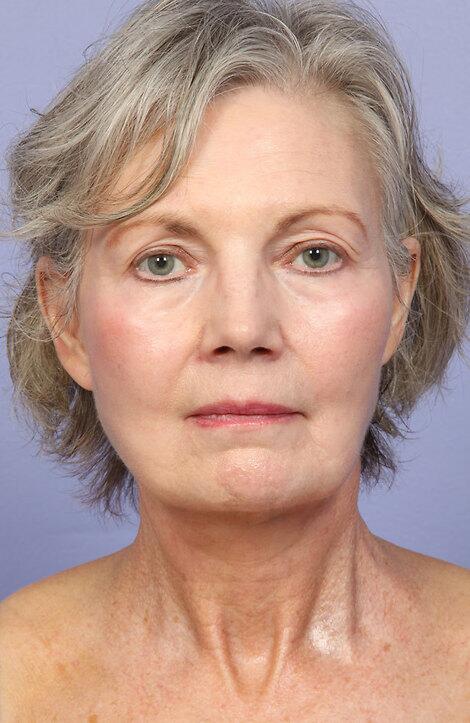 Laser Skin Resurfacing Before & After Image