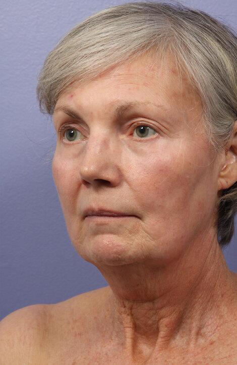 Laser Skin Resurfacing Before & After Image