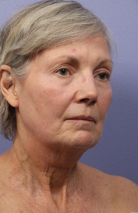 Laser Skin Resurfacing Before & After Image