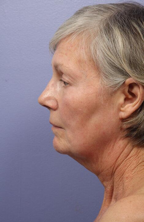 Laser Skin Resurfacing Before & After Image