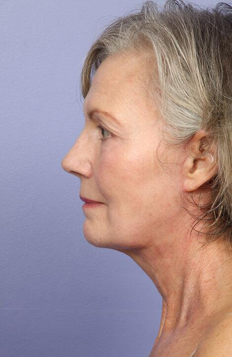 Laser Skin Resurfacing Before & After Image