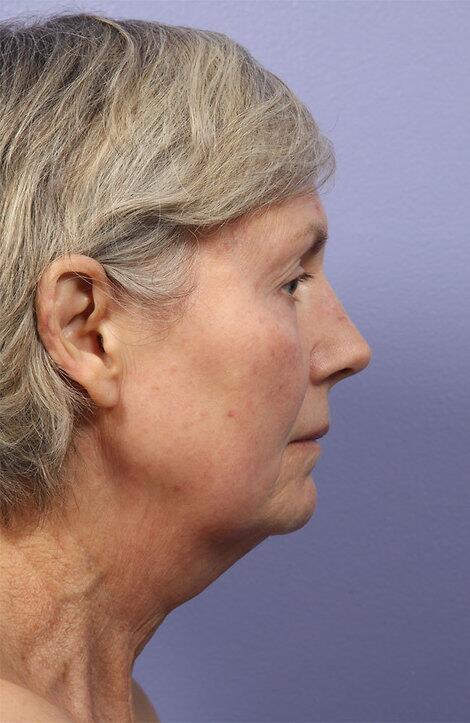 Laser Skin Resurfacing Before & After Image