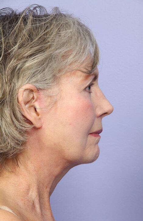 Laser Skin Resurfacing Before & After Image