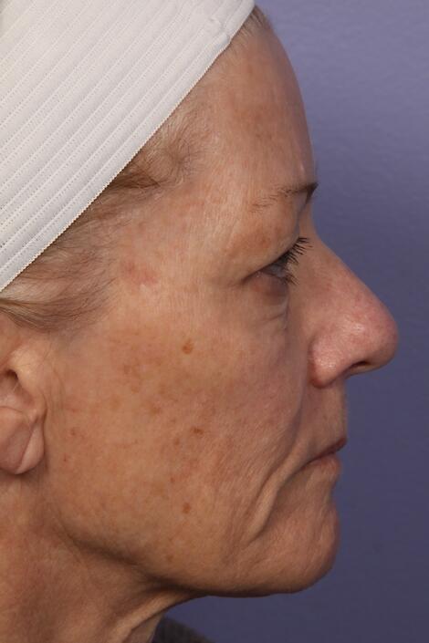 Laser Skin Resurfacing Before & After Image