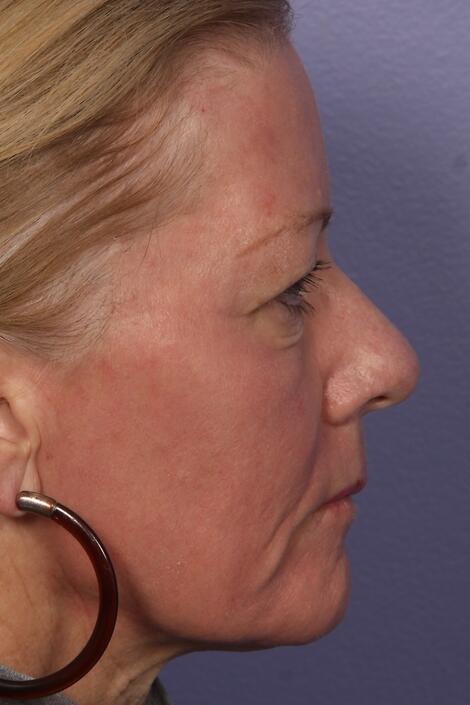 Laser Skin Resurfacing Before & After Image