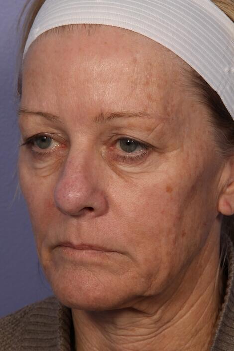 Laser Skin Resurfacing Before & After Image