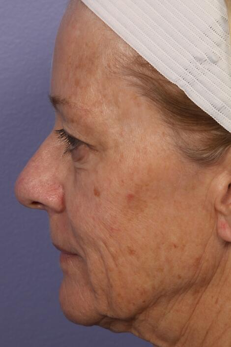 Laser Skin Resurfacing Before & After Image