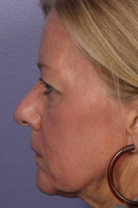 Laser Skin Resurfacing Before & After Image