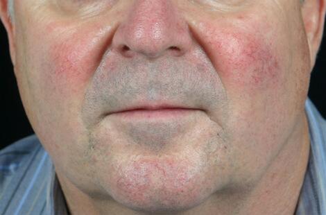 Laser Skin Resurfacing Before & After Image