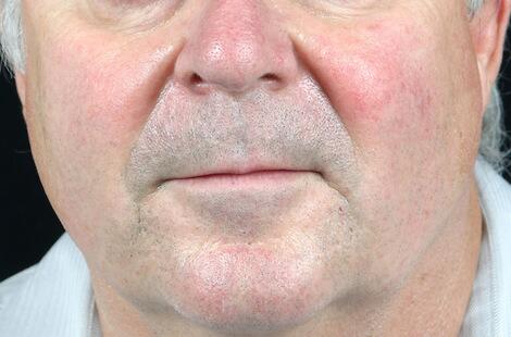 Laser Skin Resurfacing Before & After Image