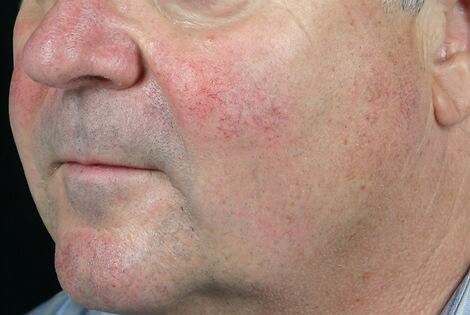 Laser Skin Resurfacing Before & After Image