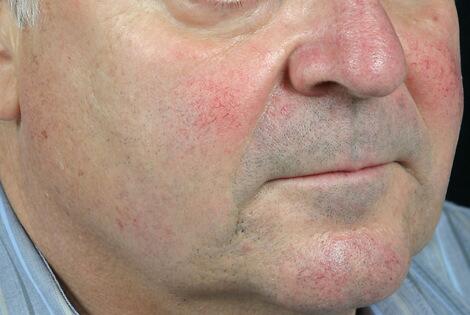 Laser Skin Resurfacing Before & After Image