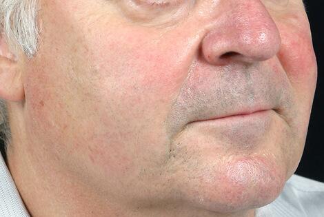 Laser Skin Resurfacing Before & After Image