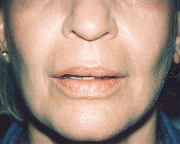 Laser Skin Resurfacing Before & After Image