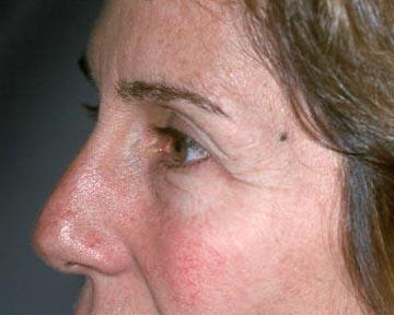 Laser Skin Resurfacing Before & After Image