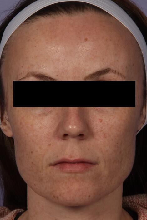 Laser Skin Resurfacing Before & After Image