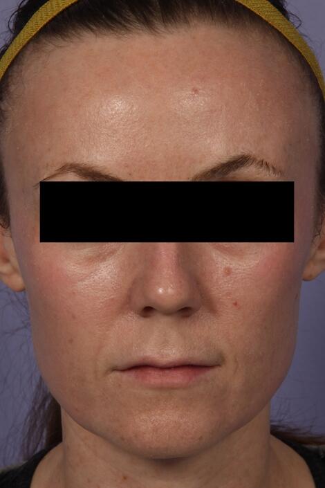 Laser Skin Resurfacing Before & After Image