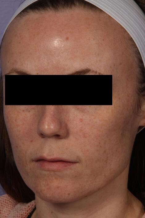 Laser Skin Resurfacing Before & After Image