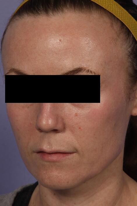 Laser Skin Resurfacing Before & After Image