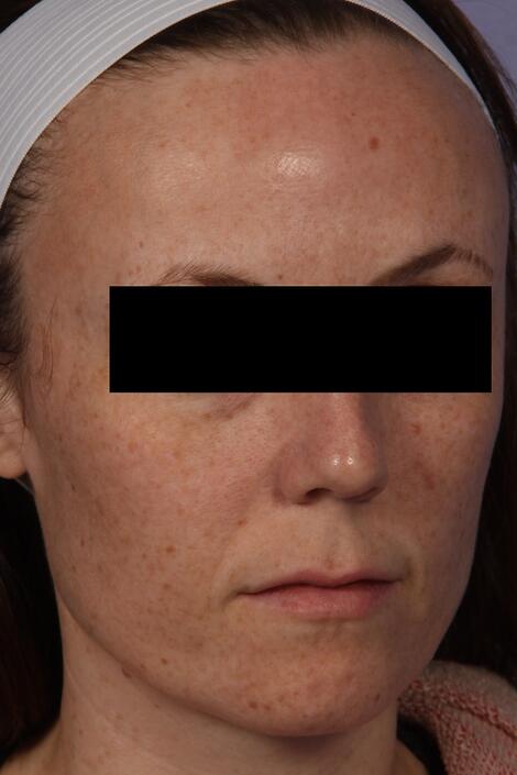 Laser Skin Resurfacing Before & After Image