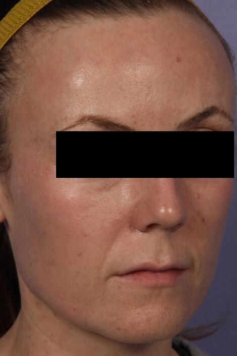 Laser Skin Resurfacing Before & After Image