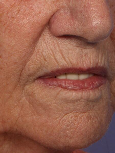 Laser Skin Resurfacing Before & After Image